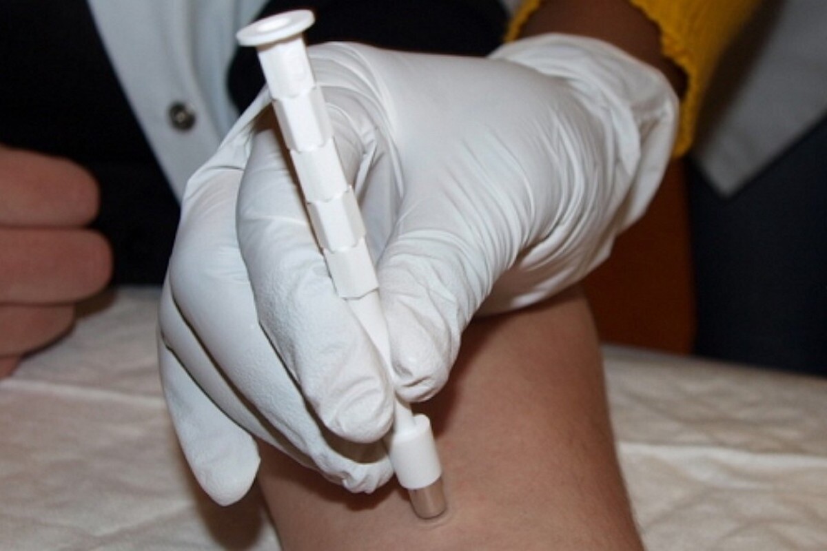 Biopsie de la peau : un examen pour en savoir plus