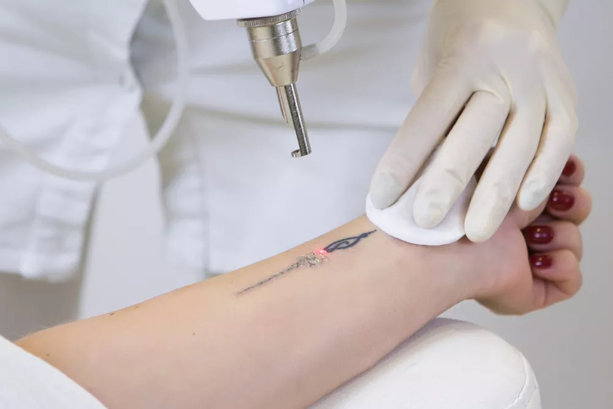 Effacer un tatouage? Le détatouage laser à la loupe