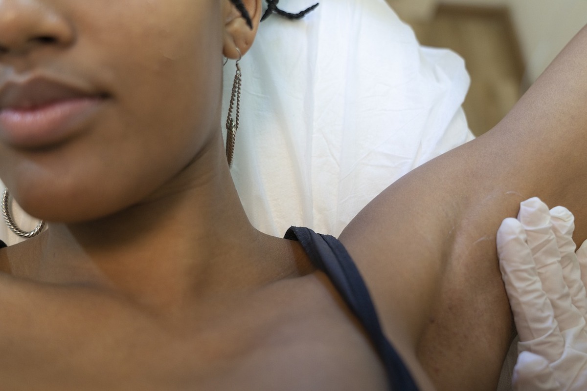 Épilation laser : adieu aux poils pour une peau lisse