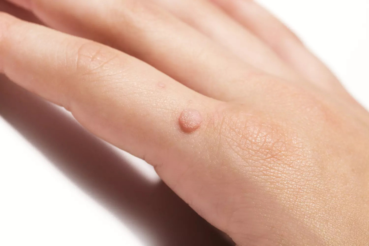 Verrues : les différentes formes et comment les reconnaître